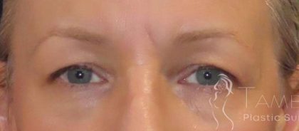 Eyelid Lift Before & After Patient #1726