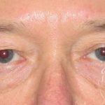 Eyelid Lift Before & After Patient #1729