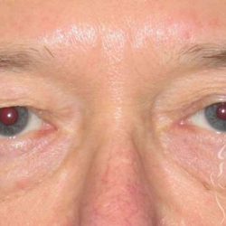 Eyelid Lift Before & After Patient #1729