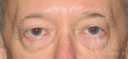 Eyelid Lift Before & After Patient #1729