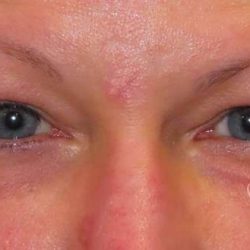 Eyelid Lift Before & After Patient #1732