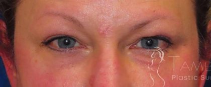 Eyelid Lift Before & After Patient #1732