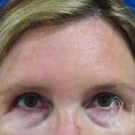 Brow Lift Before & After Patient #1735