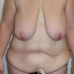 Breast Lift Before & After Patient #1937