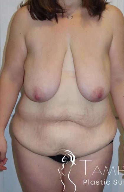 Breast Lift Before & After Patient #1937