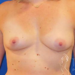 Breast Augmentation Before & After Patient #2000