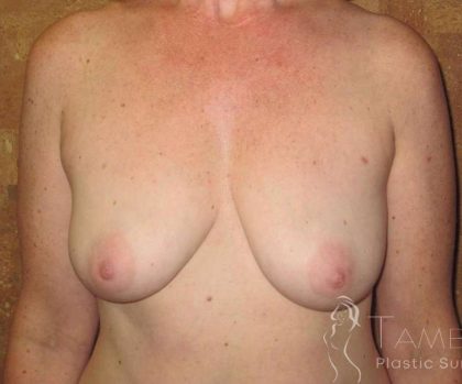 Breast Augmentation Before & After Patient #2022
