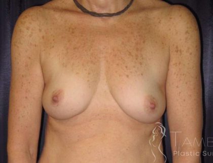 Breast Augmentation Before & After Patient #2063