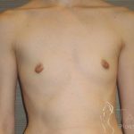 Breast Augmentation Before & After Patient #2081