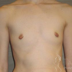 Breast Augmentation Before & After Patient #2081