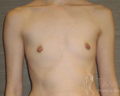 Breast Augmentation Before & After Patient #2081