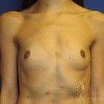 Breast Augmentation Before & After Patient #2108