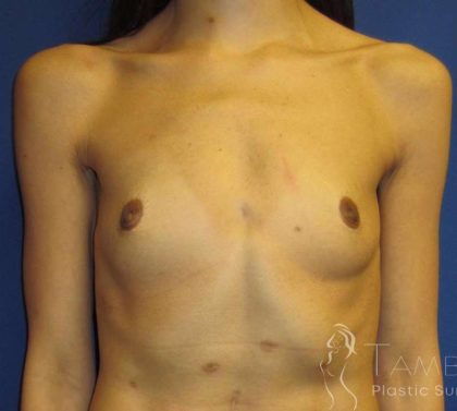 Breast Augmentation Before & After Patient #2108