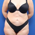 Lower Body Lift Before & After Patient #598