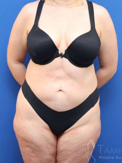 Lower Body Lift Before & After Patient #598