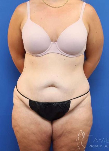 Lower Body Lift Before & After Patient #611