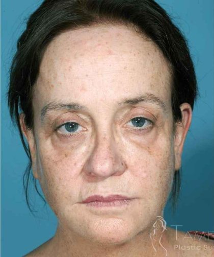 Chemical Peel Before & After Patient #436