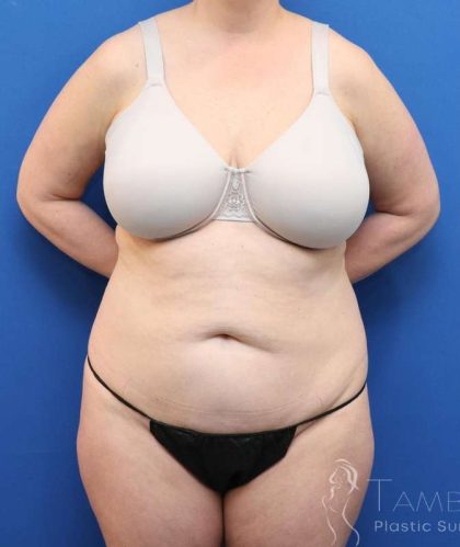 Liposuction Before & After Patient #641