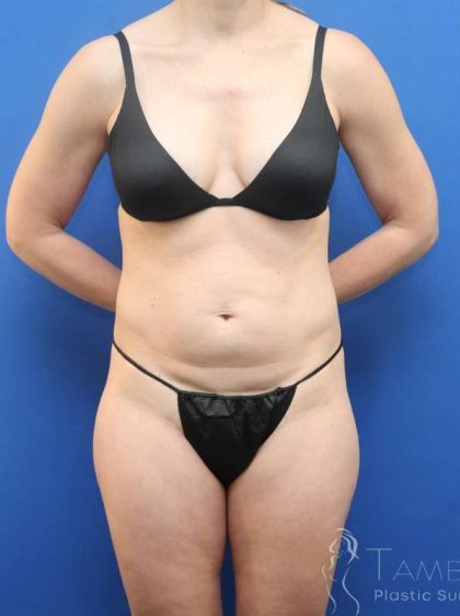Liposuction Before & After Patient #652