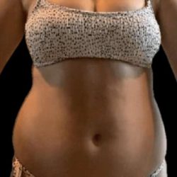 Liposuction Before & After Patient #655
