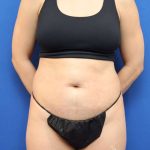 Liposuction Before & After Patient #668
