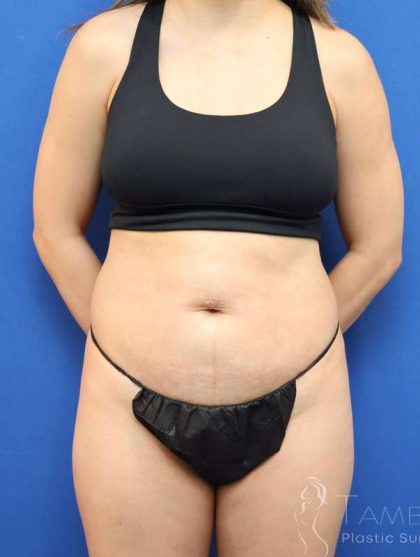 Liposuction Before & After Patient #668