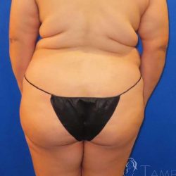 Liposuction Before & After Patient #684