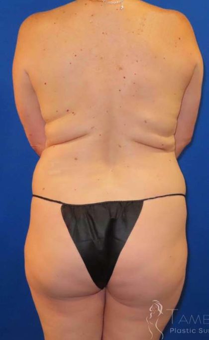 Liposuction Before & After Patient #689