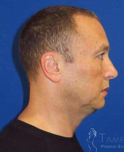 Liposuction Before & After Patient #707