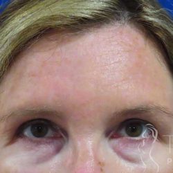Restylane® Before & After Patient #439