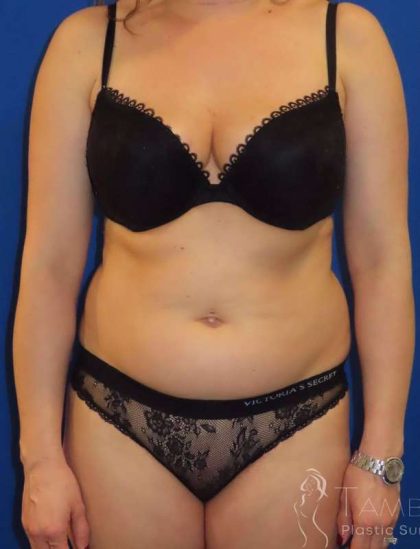 Liposuction Before & After Patient #749