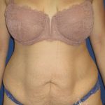 Liposuction Before & After Patient #758