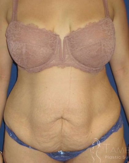 Liposuction Before & After Patient #758
