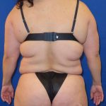 Liposuction Before & After Patient #761