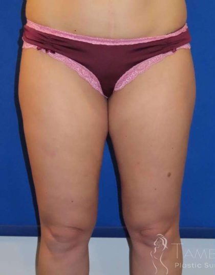 Liposuction Before & After Patient #764
