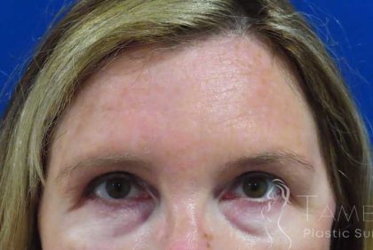 Juvéderm® Before & After Patient #442