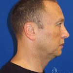 Liposuction Before & After Patient #802
