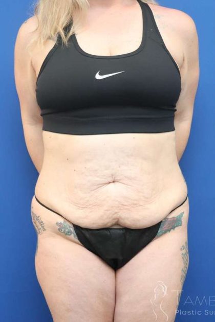 Liposuction Before & After Patient #852