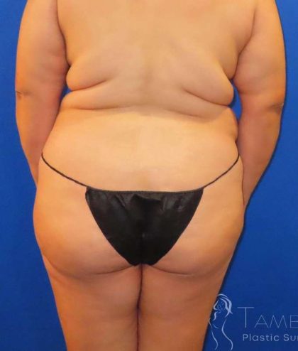 Brazilian Butt Lift Before & After Patient #912