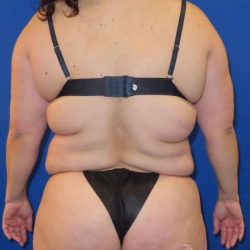 Brazilian Butt Lift Before & After Patient #915
