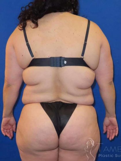 Brazilian Butt Lift Before & After Patient #915