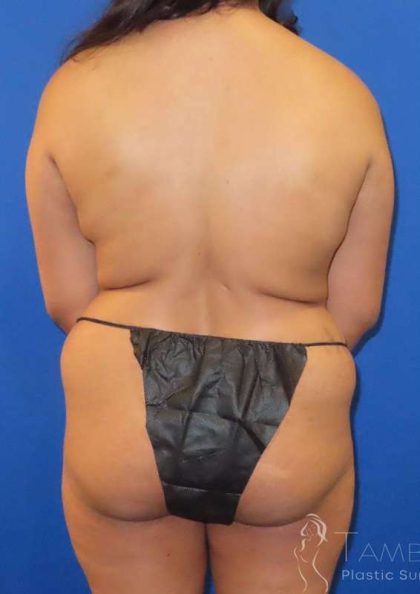 Brazilian Butt Lift Before & After Patient #918