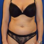 Smartlipo&reg; Before & After Patient #452