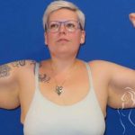 Arm Lift Before & After Patient #1096