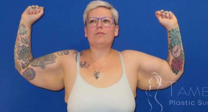 Arm Lift Before & After Patient #1096