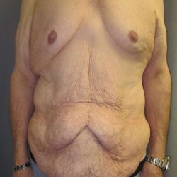 After Weight Loss Surgery Before & After Patient #1112