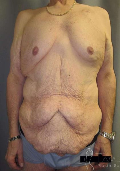 After Weight Loss Surgery Before & After Patient #1112