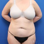 Tummy Tuck Before & After Patient #1142