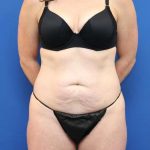 Tummy Tuck Before & After Patient #1153