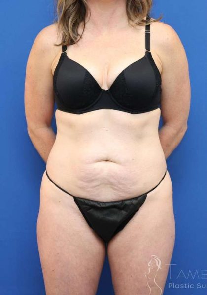 Tummy Tuck Before & After Patient #1153